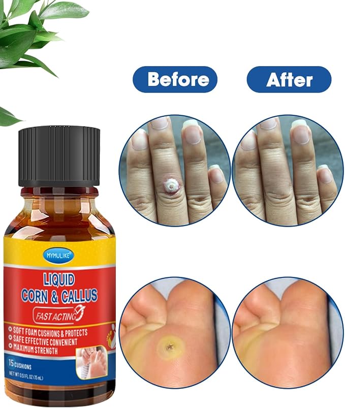 Liquid Corn Remover, Corn Removers - Image 4